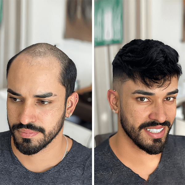 Hair Patch in Hyderabad - Reborn Hair Fixing Studio