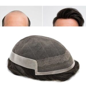 Non Surgical Hair replacement unit for men